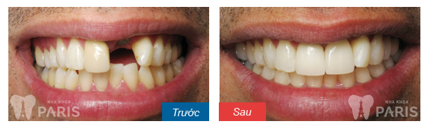 before-after-dental-implant-restoration