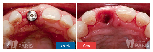 gum-graft-around-implant-before-after