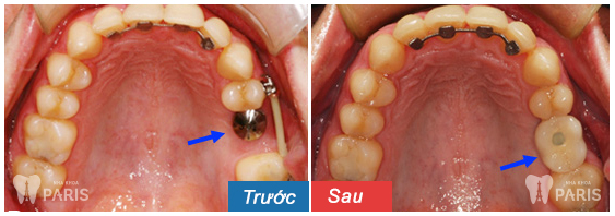 implant-dentaire-restauration-molaire-07323665BJj