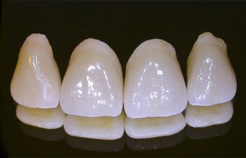 Khi phục hình răng có nên làm răng sứ hay không ?