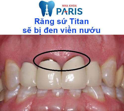 răng sứ titan có bị đen không