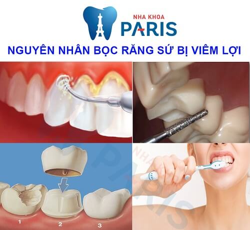 nguyên nhân bọc răng sứ bị viêm lợi