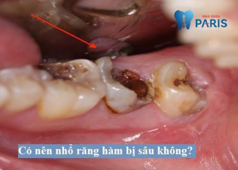 Giải đáp: Có nên nhổ răng hàm bị sâu để trồng răng không?
