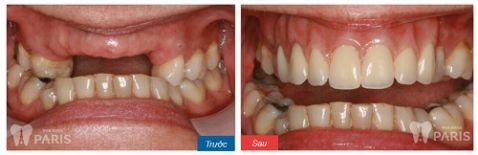 Làm cầu răng sứ, trồng lại răng mất Không đau - Tiết kiệm - Hiệu quả 7