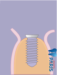 quy trình trồng răng implant - đóng nướu