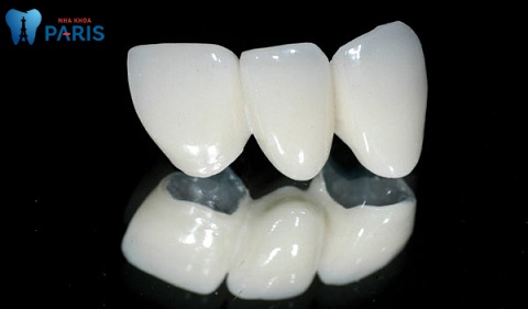 Không nên làm dải cầu răng sứ bằng titan vì chúng khá nặng, dễ bị đổi màu