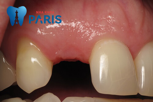 Trồng răng Implant - Giải pháp phục hồi răng mất toàn diện 6