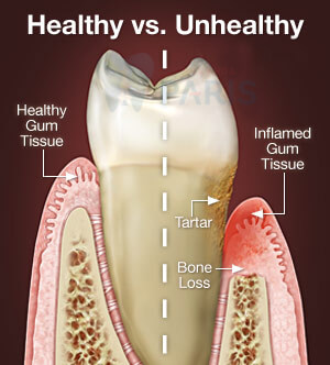 Trồng răng Implant - Giải pháp phục hồi răng mất toàn diện 7
