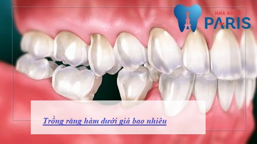 Trồng răng hàm giá bao nhiêu tiền là rẻ Trồng răng hàm giá bao nhiêu tiền là rẻ
