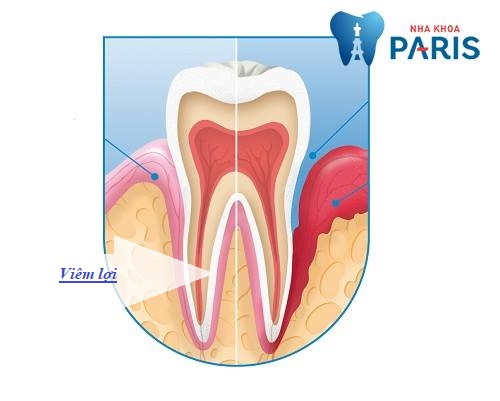 biến chứng sau khi bọc răng sứ