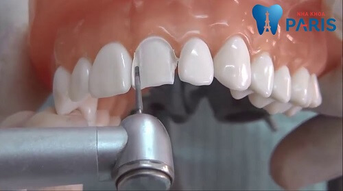 Răng sứ có mài được không? Tiến sĩ Đàm Ngọc Trâm giải đáp