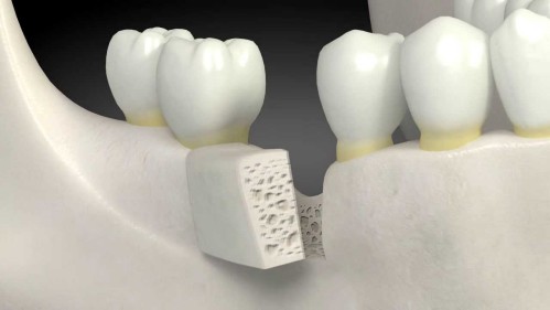 Ghép xương răng là gì, ghép xương răng có đau không, chi phí ra sao? 4