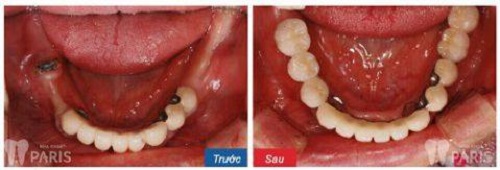 Răng cấm có nhổ được không