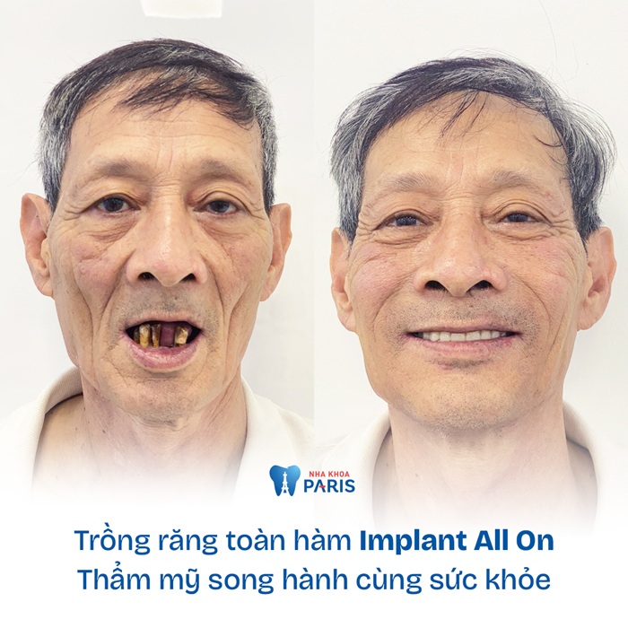 Hình ảnh khách hàng trồng răng tại Paris toàn hàm