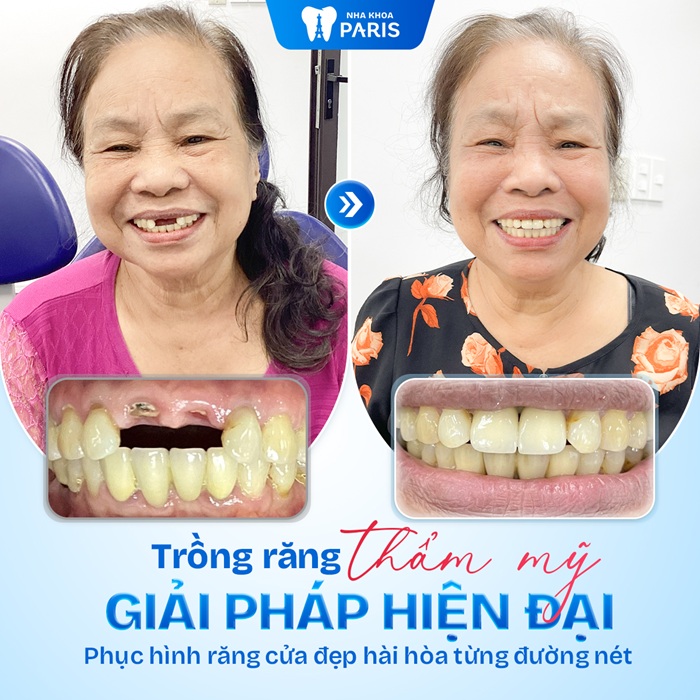 Trải nghiệm tích cực sau khi trồng răng ở Paris